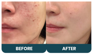 lek wajah atau hiperpigmentasi seringkali menjadi masalah yang mengganggu penampilan/ Foto dr. Belle Aesthetic Clinic